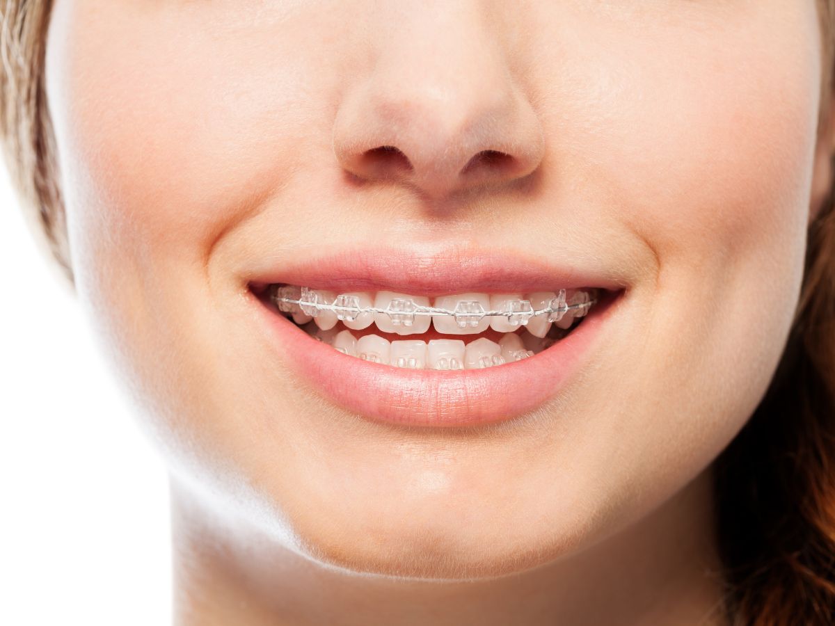 Người đi làm có nên niềng răng không Yenle Dental 